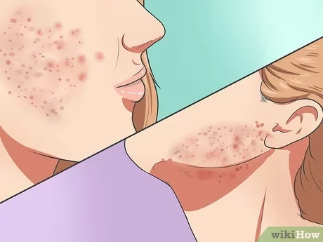 Accutane Nom Generique