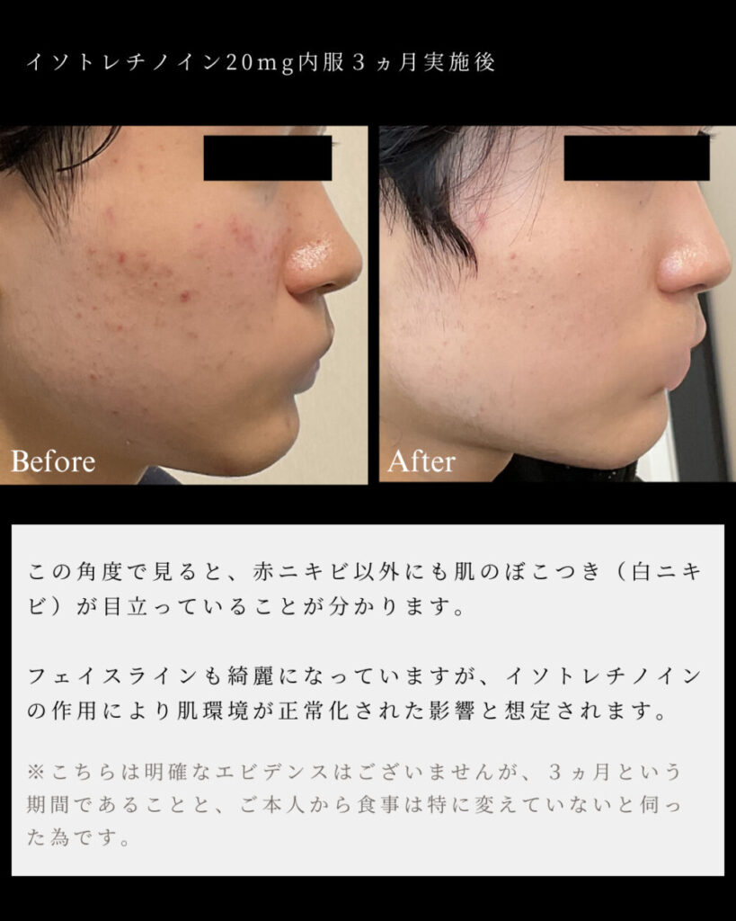 Isotretinoin moins cher