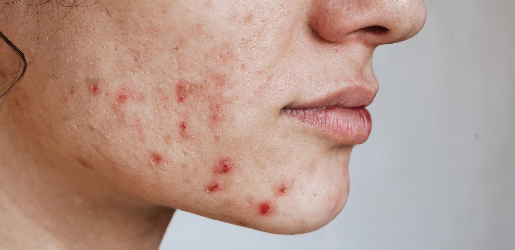 roaccutane vente en ligne