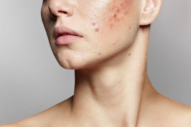 pilule contre roaccutane