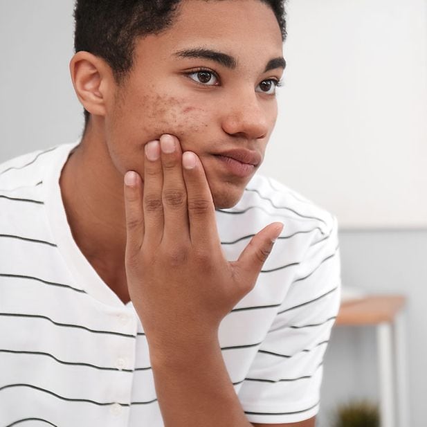 Comment Acheter Du Roaccutane