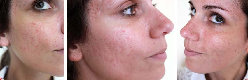 Roaccutane apres arret pilule