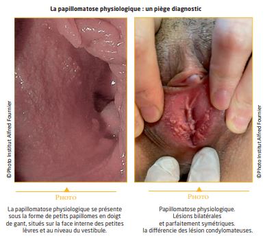Traitement aldara sans ordonnance
