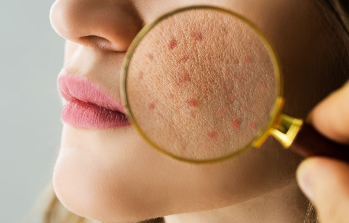 Prix medicament roaccutane