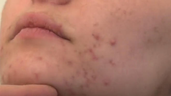 Roaccutane sans pilule