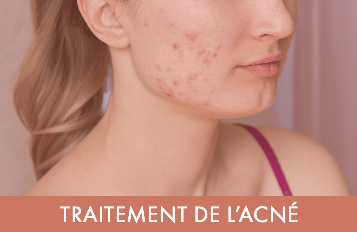 prix traitement roaccutane
