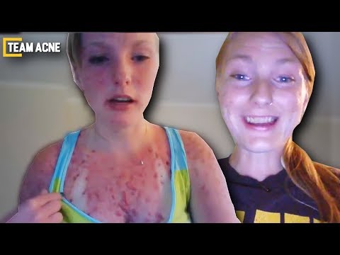 accutane online italia