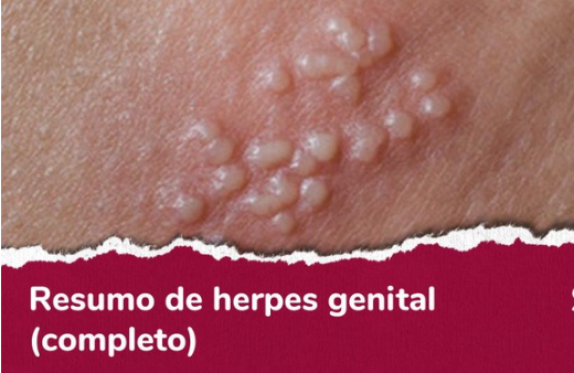 Aciclovir De 200mg Ou 400mg