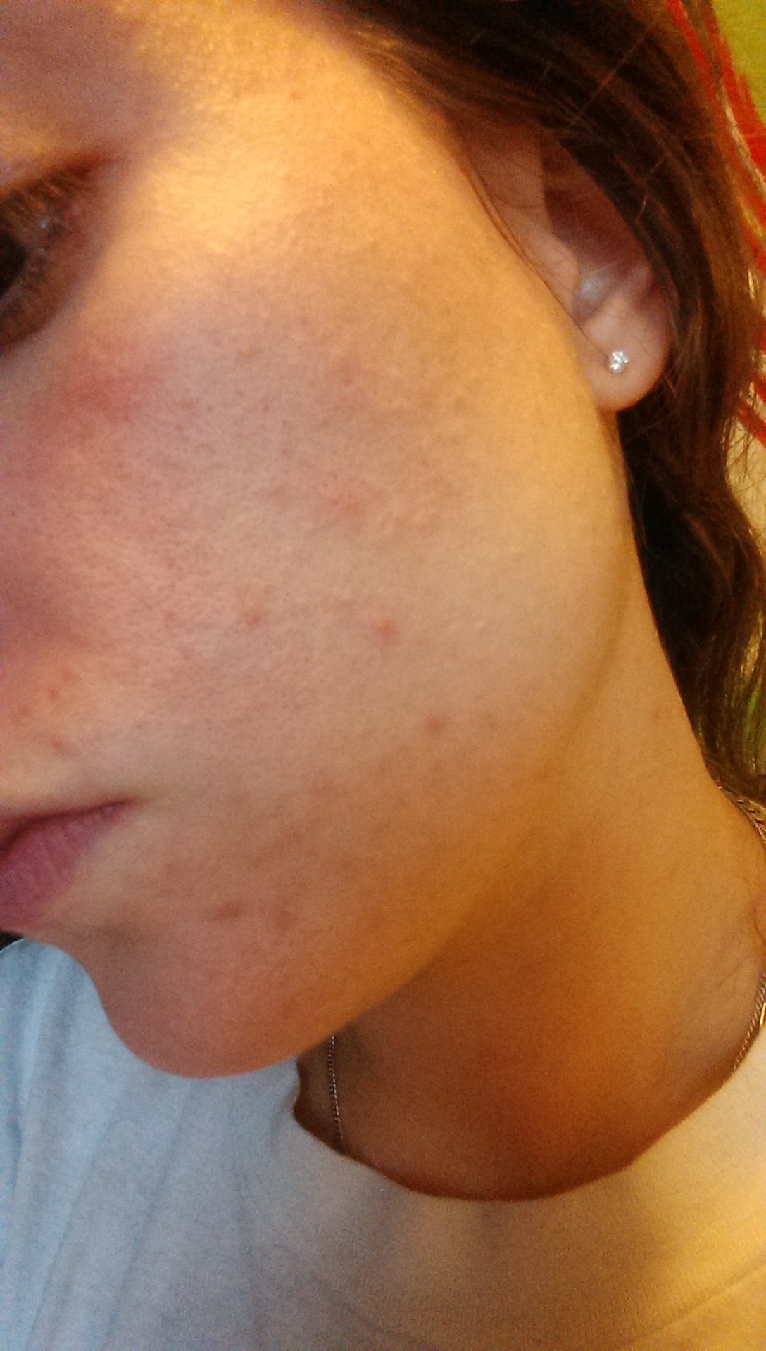 Roaccutane Pilules