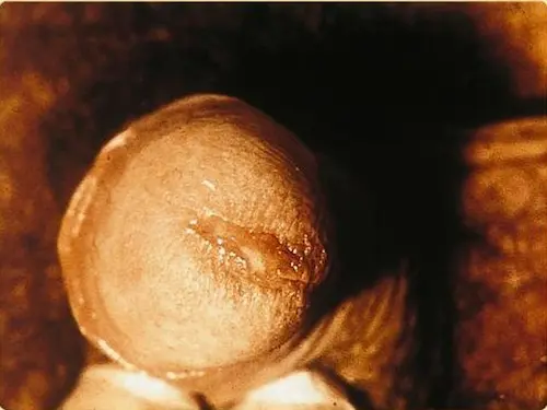 Doxycycline Chlamydia Online