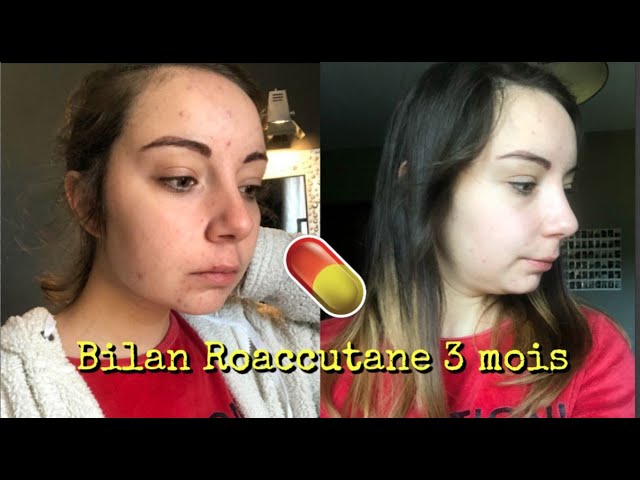 Roaccutane France