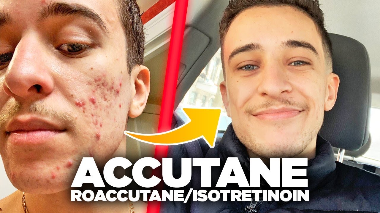 Peut on avoir accutane sans ordonnance
