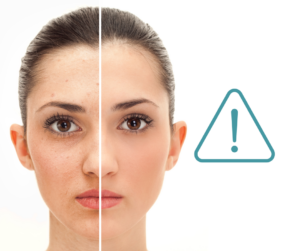 Coût du isotretinoin