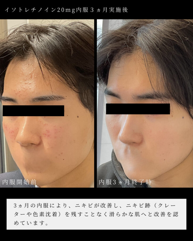 Roaccutane sans ordonnance