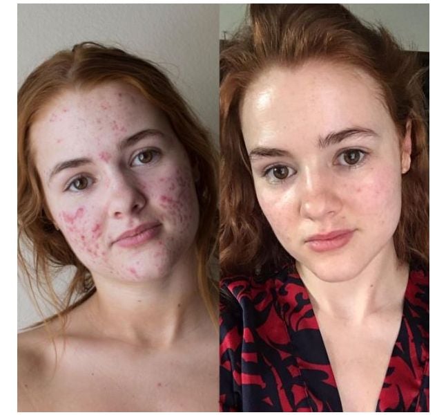 Roaccutane pas cher