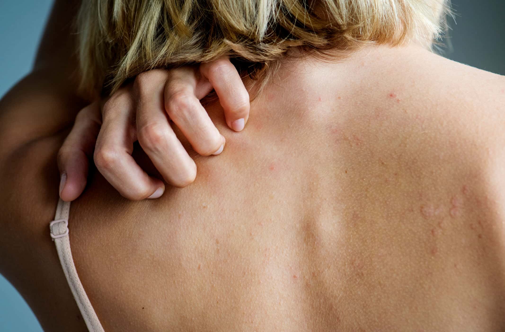 Ivermectine gale sans ordonnance