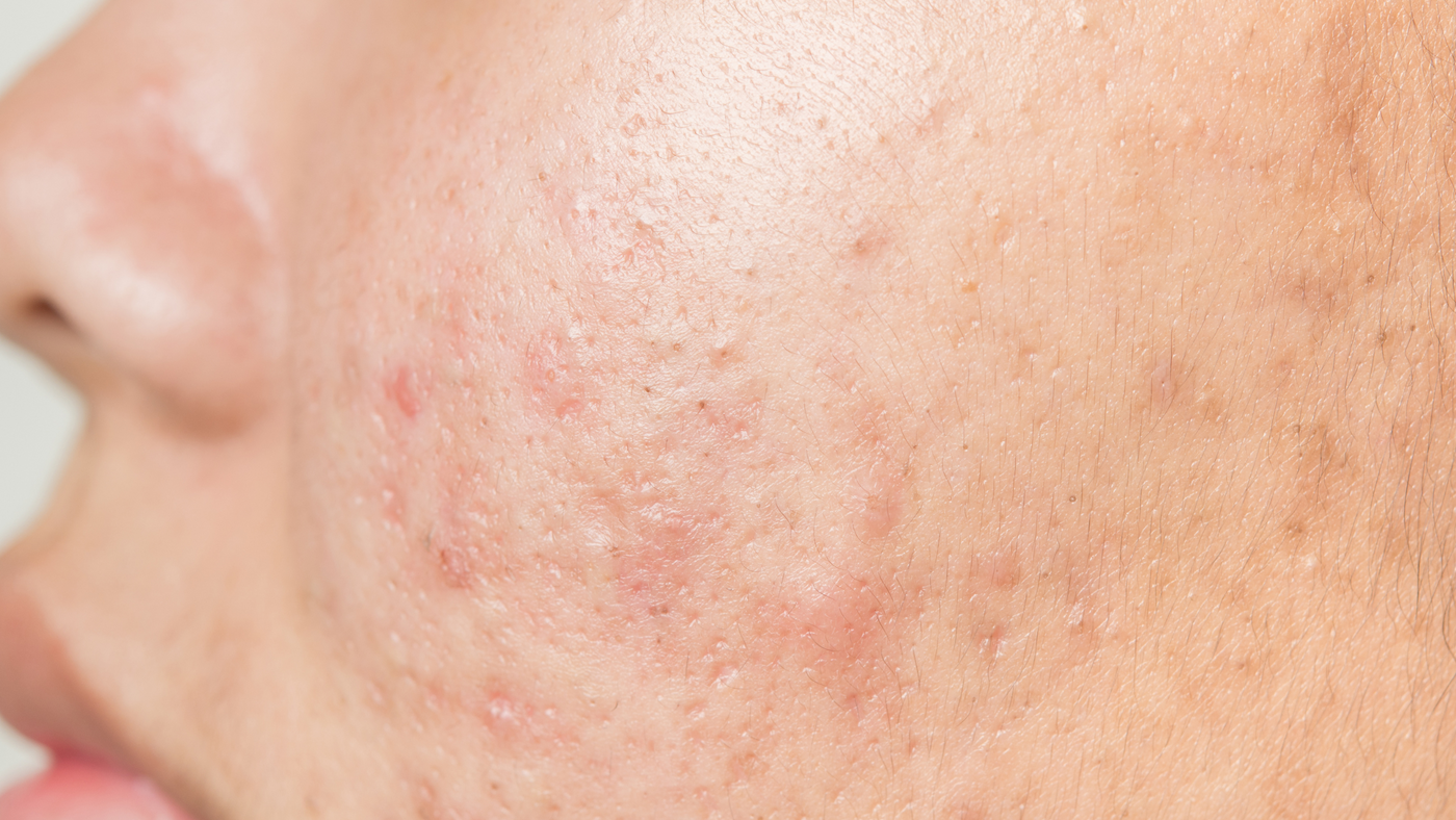 Prix roaccutane crème