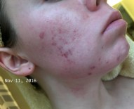 Isotretinoin 30mg online