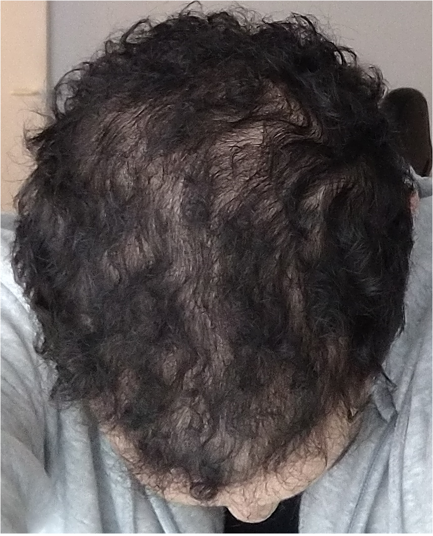 finasteride farmacia online