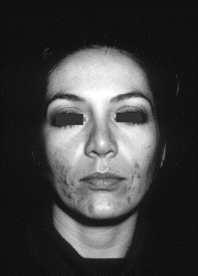 coût du roaccutane