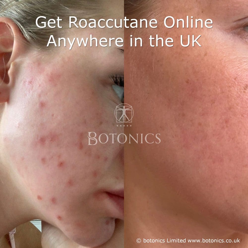 roaccutane prix france