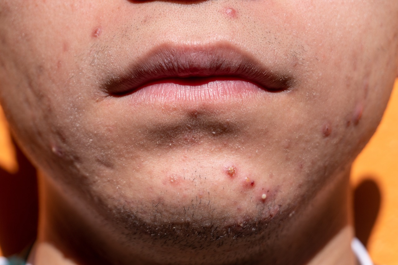Commander Du Accutane En Ligne