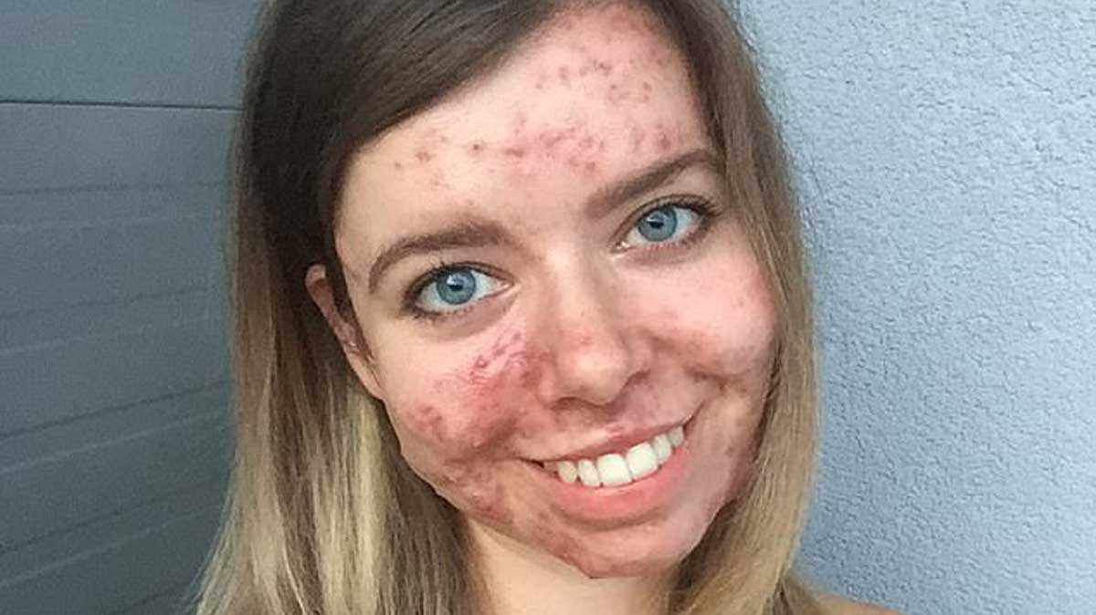 Pilule pour roaccutane
