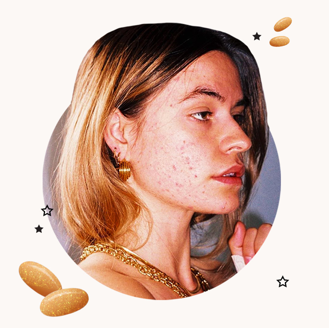 Online dermatologist accutane