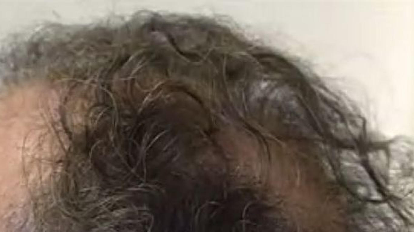 Acheter du finasteride générique