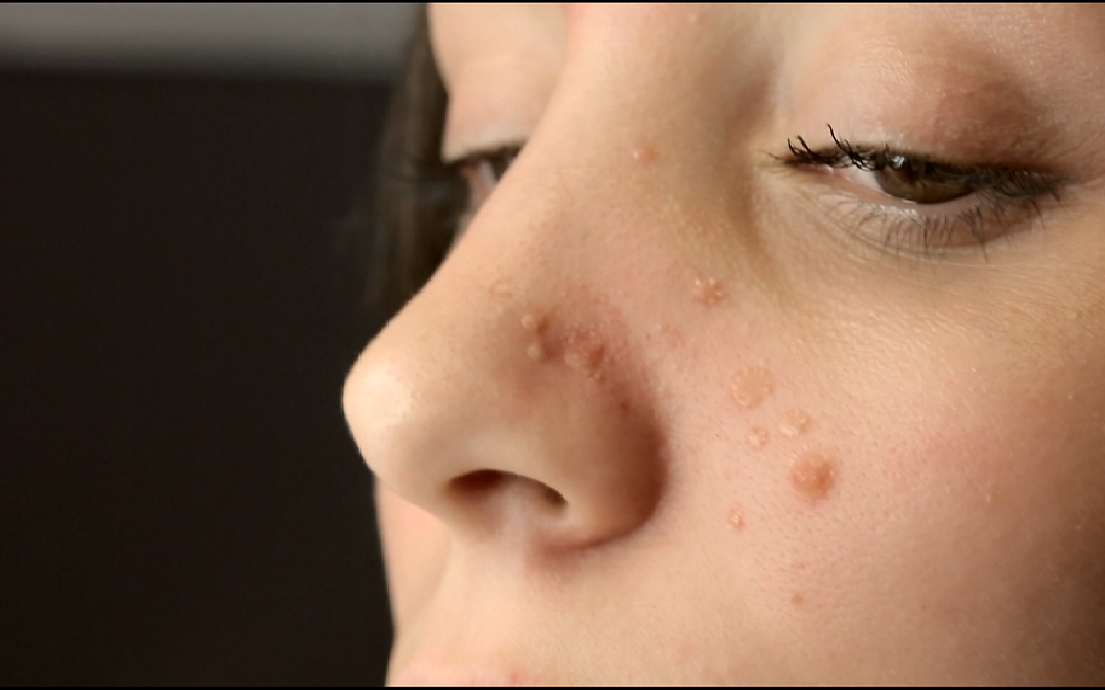 pilule sous roaccutane