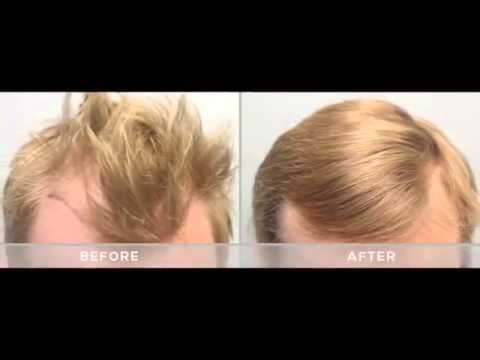 acheter finasteride bailleul