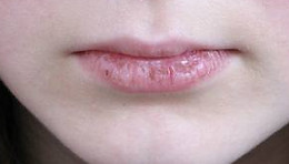 roaccutane où acheter