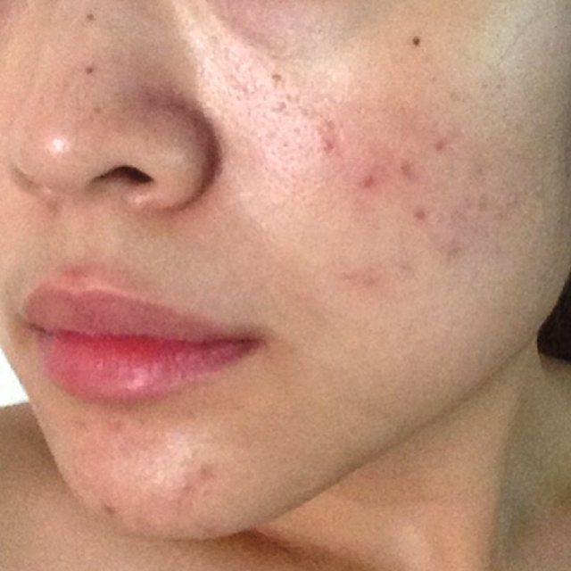 Roaccutane Cachet Prix
