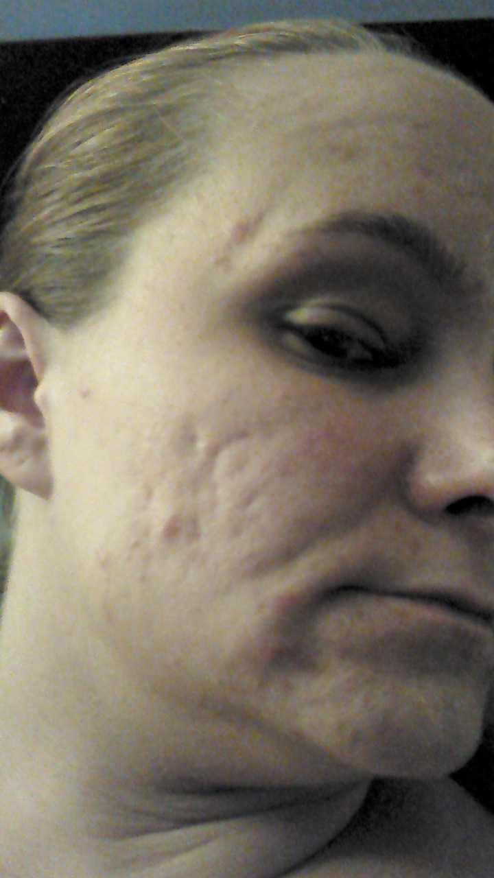 Isotretinoin 30mg