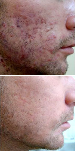 Roaccutane creme sans ordonnance