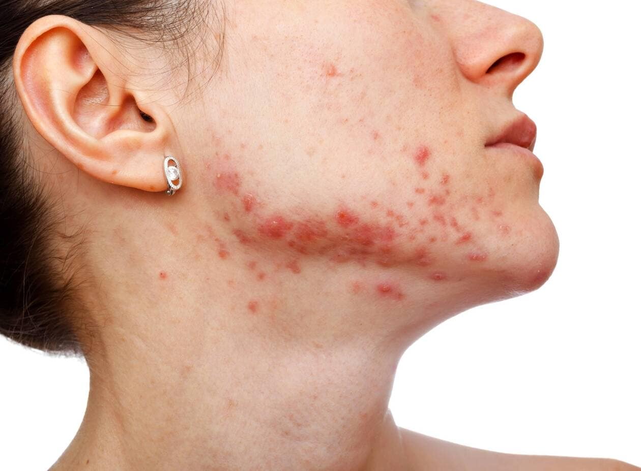 Achat Roaccutane En Ligne