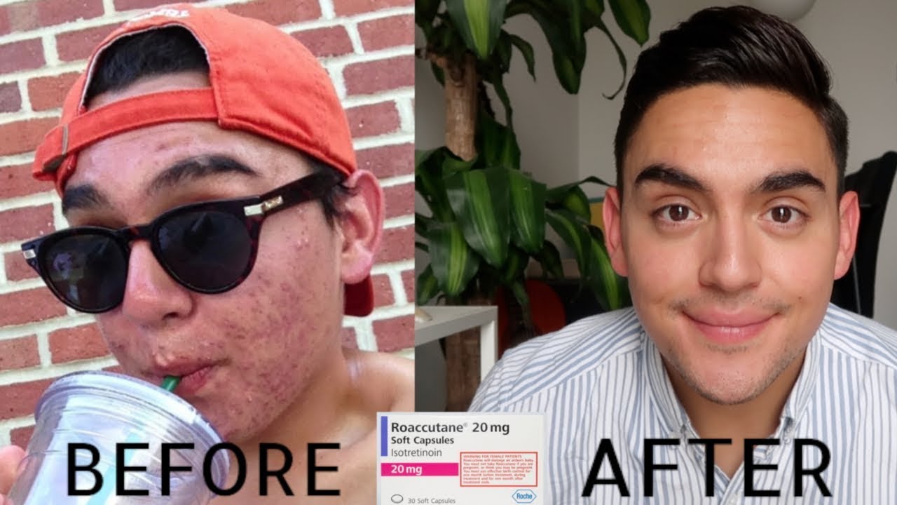 Roaccutane Gel Achat