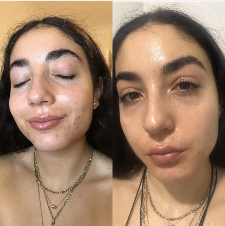 Prix Roaccutane Crème
