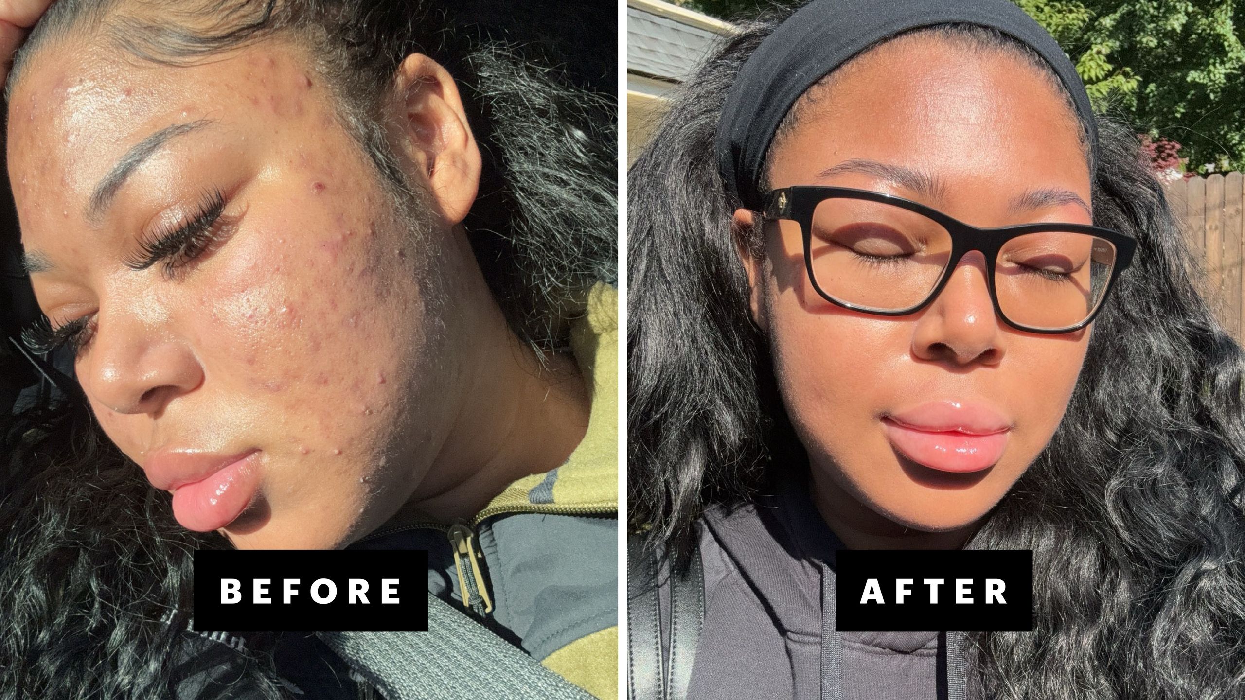 online dermatologist accutane