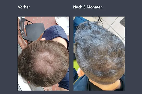 Finasteride moins cher