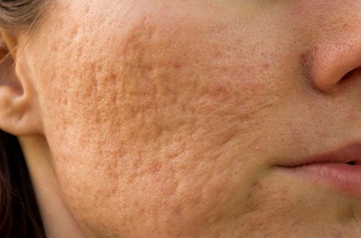 Roaccutane arret pilule
