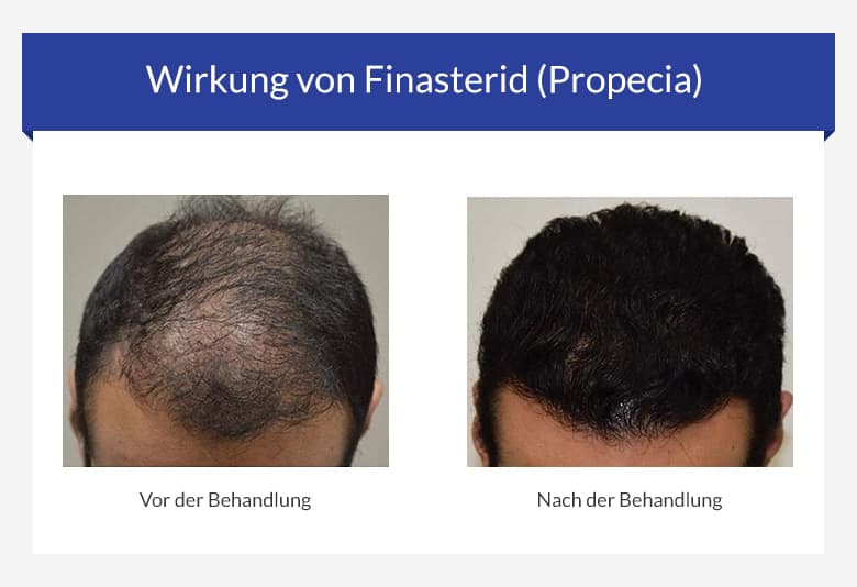 finasteride le moins cher