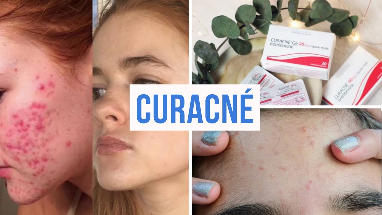 Roaccutane comprimé prix