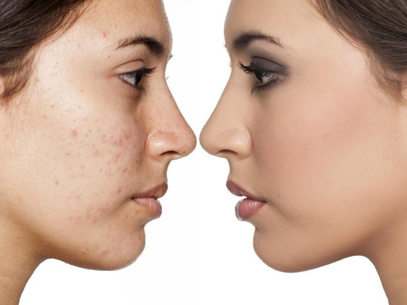 roaccutane prix 2020