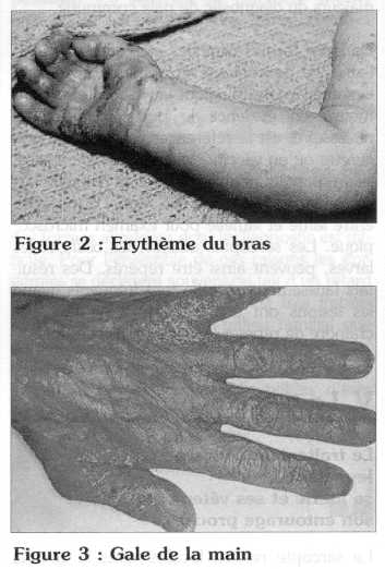 ivermectine crème sans ordonnance