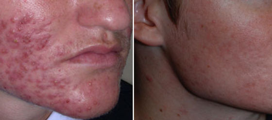 Commander Accutane Générique