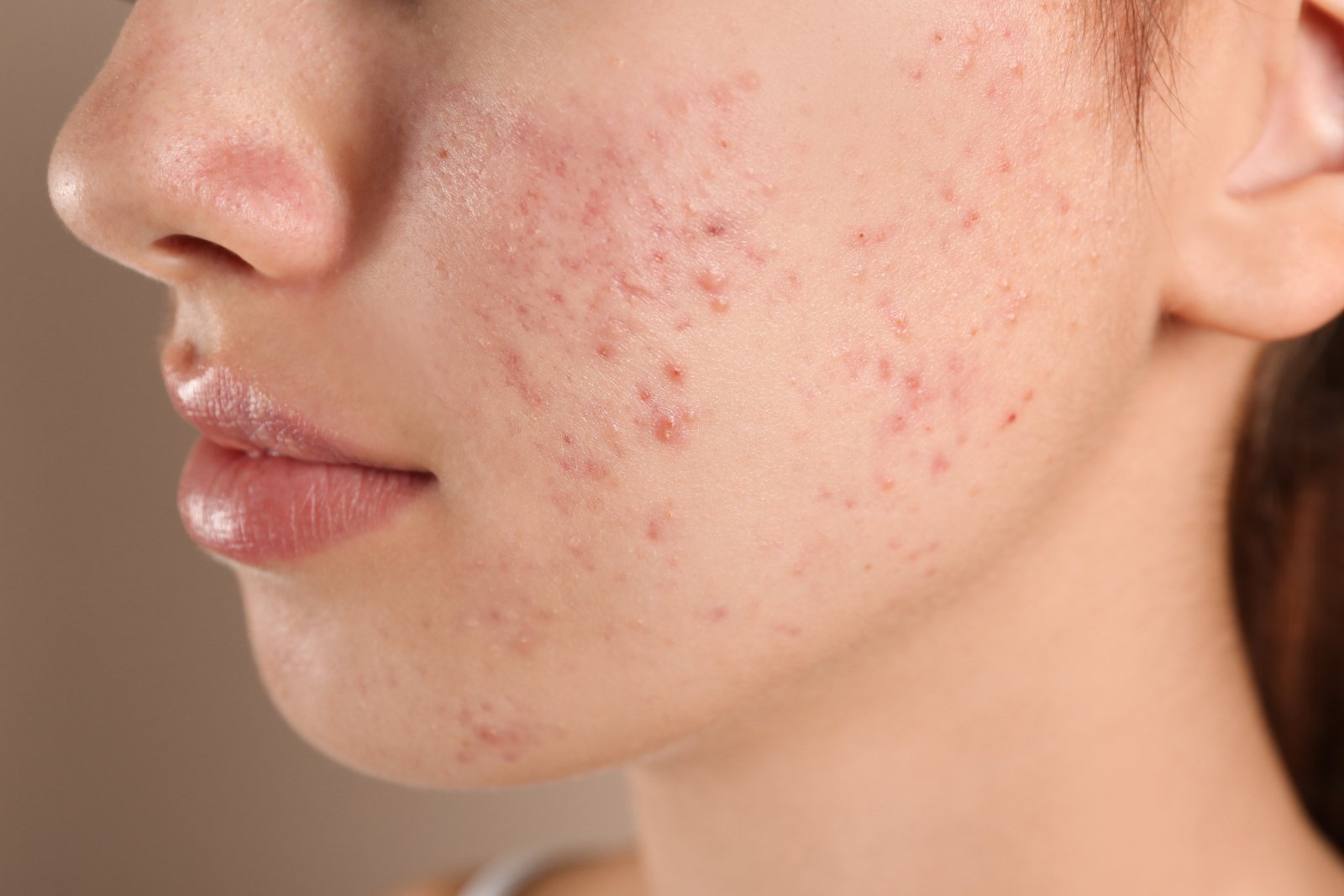 Roaccutane gel generique