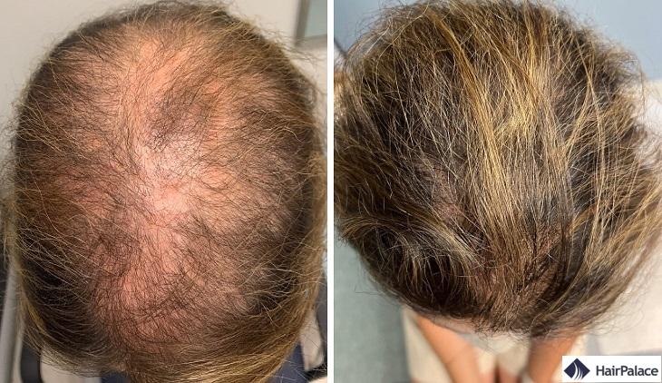 Finasteride Comment Acheter