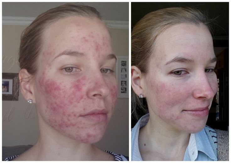 Acheter roaccutane