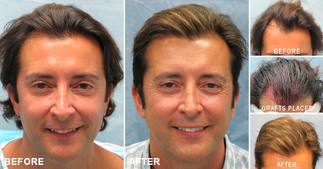 Finasteride Le Prix